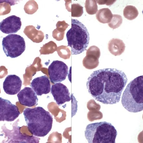 IHC: B-Cell Leukemia/Lymphoma 6 (BCL6)
